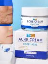 Acne Face Cream